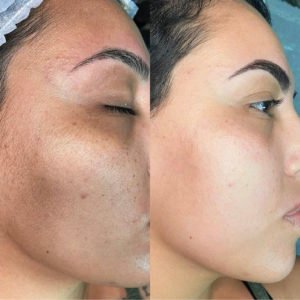 IMG_77B310697671-1-300x300 - Filler Direct Wholesale INFINI Premium BioAgePeel Online Course