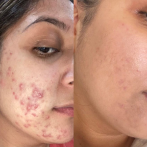 Peel-After-300x300 - Filler Direct Wholesale INFINI Premium BioAgePeel Online Course